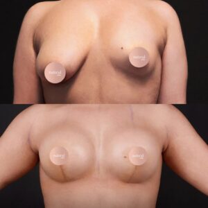 Breast-Augmentation-a55